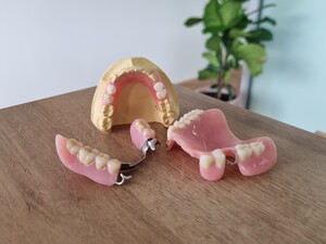 The Dental Corner Pic 5 - Partial dentures Valplast flexible acrylic chrome