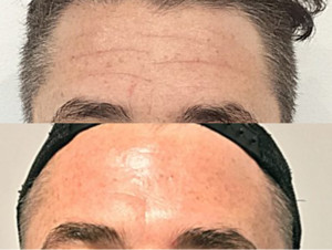 Prp For Skin Pic 3 - Smooth out lines and wrinkles thanks to our PRP for Skin treatments