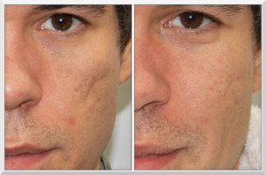 Prp For Skin Pic 5 - Acne Scarring can be noticably improved with our unique and exclusive PRP for Skin technique