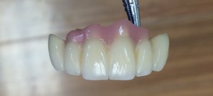 21st Century Dental Laboratory Pic 4 - Bridge Crowns