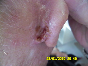 SCC SKIN CANCER CLINIC Pic 4 - squamous cell cancer of ear