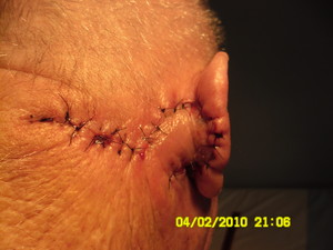 SCC SKIN CANCER CLINIC Pic 5 - SCC removed flap closure