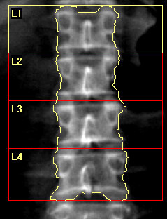 DEXA Melbourne Pic 3 - Healthy spine scan Picture Courtesy of HOLOGIC Inc and affiliates