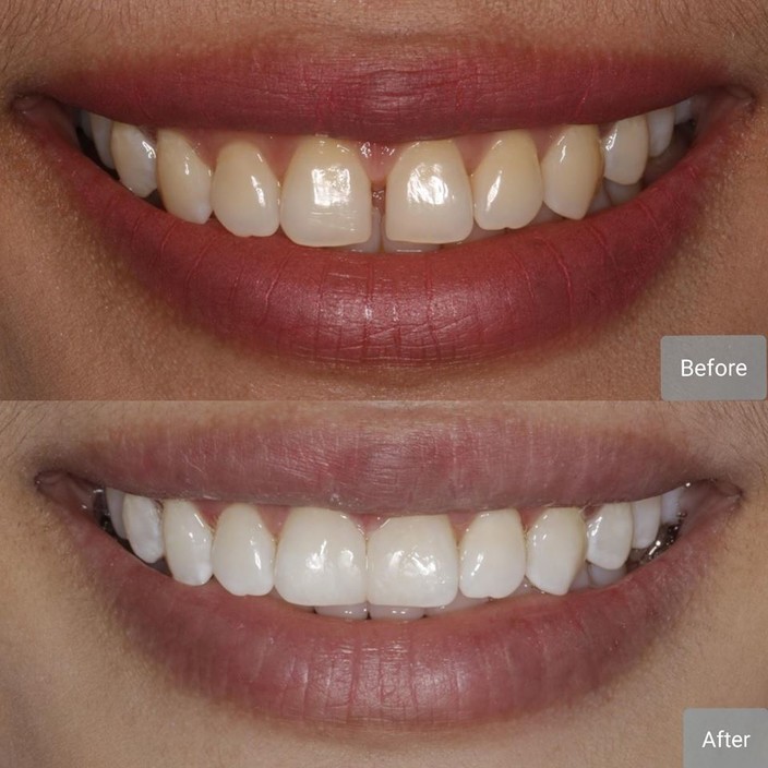 Doncaster Hill Dental Pic 1 - Composite Veneers is one of the great options available for people who would like to close gaps between their teeth but dont want to spend so much time on braces