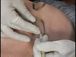 Beauty Biz Electrolysis Clinic Pic 1 - Electrolysis on eyebrows