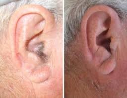 Beauty Biz Electrolysis Clinic Pic 3 - electrolysis on ears