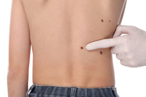 South East Skin Clinic Pic 5 - A full skin check takes 10 to 25 minutes depending on the number of moles you have