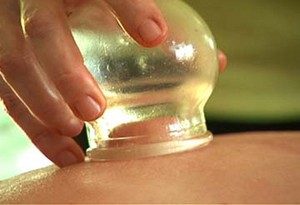 Melbourne City Massage Therapy Pic 2 - Cupping