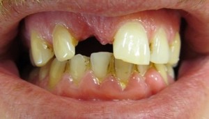 (Paul Werner) Denture Clinic Pic 2 - Its not pleasant having a tooth missing Let us help you fill the missing gaps