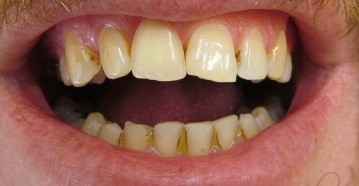 (Paul Werner) Denture Clinic Pic 1 - I simple flexible denture can me you smile again