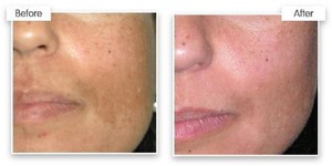 Hairstop laser hair removal clinic Sydney Pic 4 - Pigmentation removal sydney