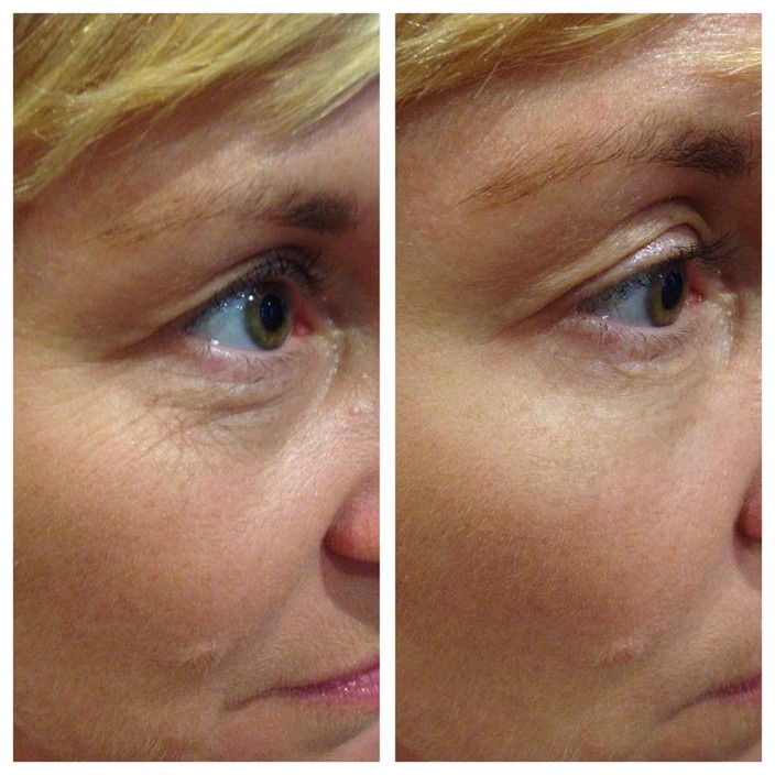 Jacinta May Youth Enhancement Pic 1 - Before and After Using LUMINESCE Cellular rejuvenation serum