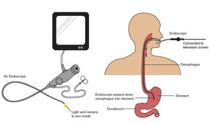 Westpoint Endoscopy Day Hospital Pic 4 - Gastroscopy