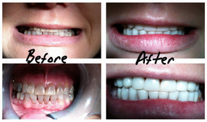 iSmile Dental Centre Pic 5 - BEFORE Antibiotic Tetracycline stained teeth AFTER Resin direct veneers