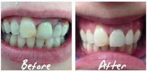 iSmile Dental Centre Pic 4 - BEFORE Grey nonvital teeth with root canal treatment AFTER Teeth Whitening All ceramic crowns