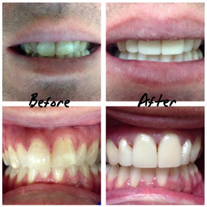 iSmile Dental Centre Pic 3 - BEFORE Larger top front teeth buck teeth appearance yellow teeth AFTER Porcelain Veneers with Teeth Whitening