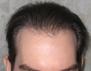 Hair Transplant Abroad Pic 4