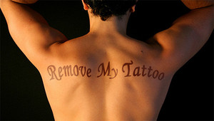 Tattoo Removal Pic 2