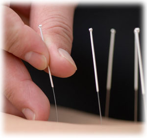 Sustain Health Pic 4 - acupuncture