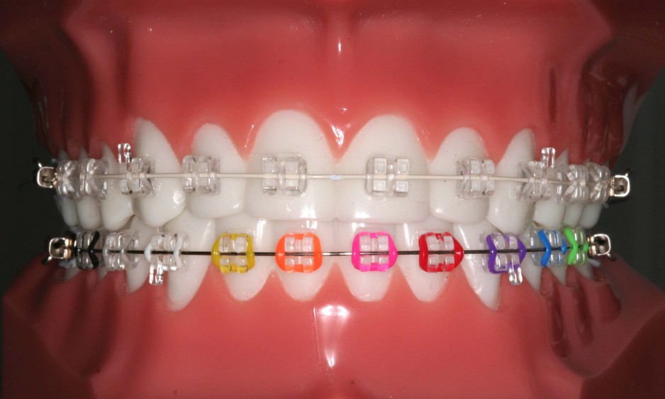 Barbera Andrew Dr Pic 1 - ceramic braces