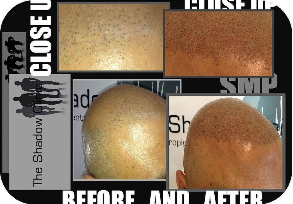 The Shadow Clinic Pic 1 - The Scalp Micro Pigmentation Before and After