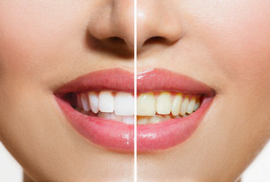 Esteem Dental Care Pic 4 - Teeth Whitening