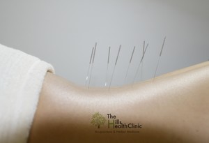 The Hills Health Clinic Acupuncture and Herbal Medicine Pic 3 - Acupuncture