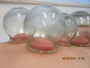 Acupuncture and Chinese Medicine Maroubra Clinic Pic 3 - Cupping