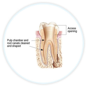 Malvern Endodontics Pic 4 - A small access is carefully made on top or back of the affected tooth to remove the infected pulp using specially designed root canal instruments