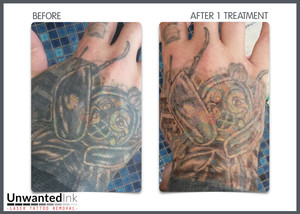 Unwanted Ink Laser Tattoo Removal Pic 2 - With 4 layers of tattoos this was possibly the most inked up hand weve ever seen The progress shot taken just 1 week treatment shows just how powerful laser tattoo removal can b