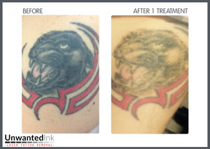 Unwanted Ink Laser Tattoo Removal Pic 3 - After just one hit our new laser made short work of this black panther We not treating the red as its getting used in the new artwork