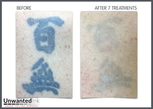 Unwanted Ink Laser Tattoo Removal Pic 5 - Sometimes the stuff you liked in your 20s just isnt your thing anymore These characters were hammered in there pretty hard but they still dont stand a chance with our laser