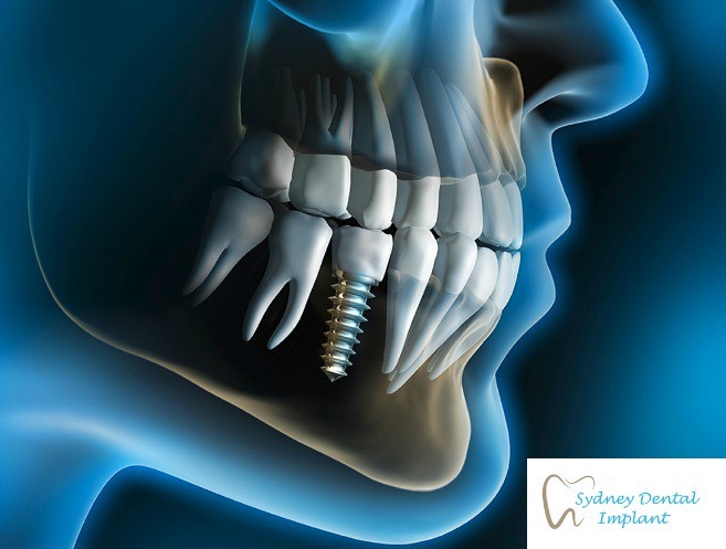 Sydney Dental Implant Pic 1