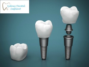 Sydney Dental Implant Pic 3