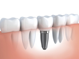 Lobethal Dental Centre Pic 2 - Implants