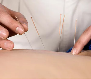 Modality Massage Pic 5 - Myofascial Dry Needling