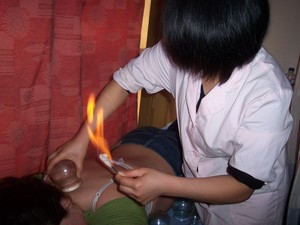 Acupuncture & Traditional Chinese Medicine Pic 3 - Cupping