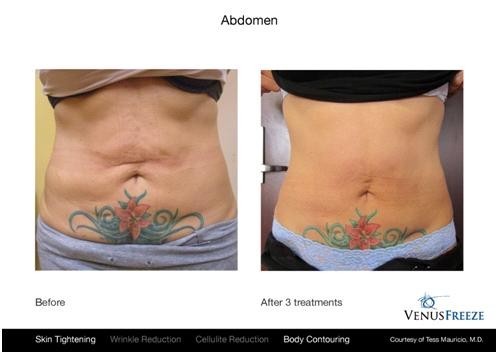 Liposuction Surgery at Melbourne Pic 2 - liposuction