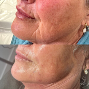 The Tox Fox Pic 2 - Dermal fillers before and after Gisborne