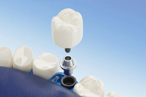 Blue Spa Dental Pic 3