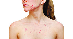 Dermal Solution Pic 2 - Got Zits Believe it or not acne does not need to be a rite of passage for teens At the Dermal Solution Skin Clinic we can tailor a simple yet effective solution Call today