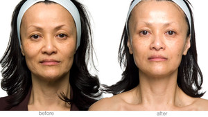 Salon Secrets Pic 2 - bt Hydrodermabrasion before and after sessions Results vary depending on your age and skin condition