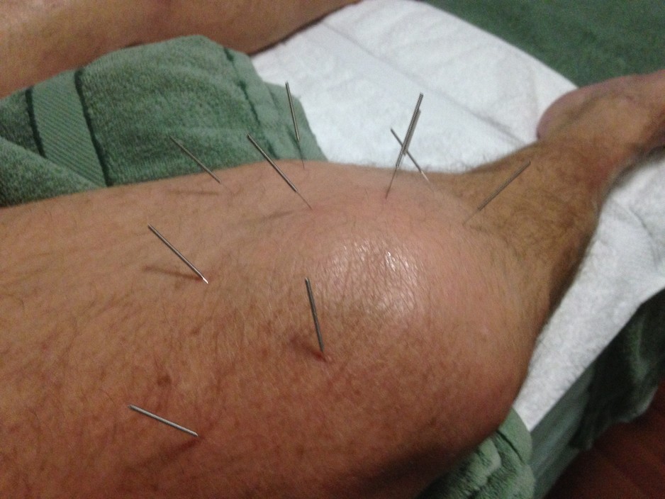 Queanbeyan Massage Centre Pic 2 - Dry needling