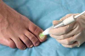 Casey Foot Clinic - Shockwave Therapy Pic 4 - Fungal Nail Laser