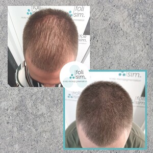 Foli Sim SMP Pic 4 - SMP to add greater thickness and density to thinning hair