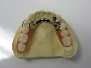 Hi-Tech Dental Laboratory Pic 3 - Lower Bilateral Lingual Bar with acrylic teeth on freeend saddles