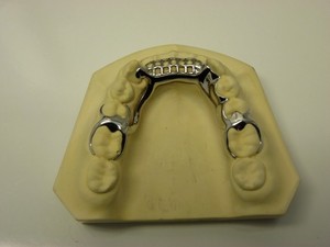 Hi-Tech Dental Laboratory Pic 4 - Lower Lingual Bar with anterior retention for acrylic teeth