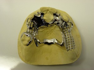 Hi-Tech Dental Laboratory Pic 5 - Upper Bilateral with open palate design