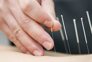 InTouch Massage Pic 5 - Myofascial Dry Needling