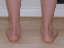 YourPodiatristBrisbane.com Pic 4 - 4 Diagnosis Flatfeet